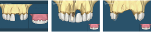 Dental Implant SLC Utah