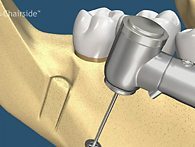 Bone Grafting Dental Implants SLC UT