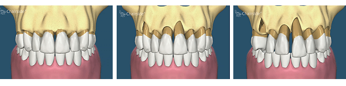 Bone Loss Due to Gum Disease Dental Implants Salt Lake City, Utah