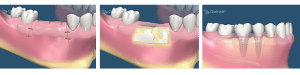 dental implants salt lake city utah
