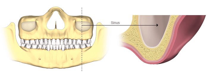 Bone Loss Sinus Cavity Dental Implants Utah