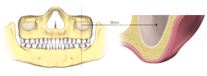 Bone Loss Sinus Cavity Dental Implants Salt Lake City UT