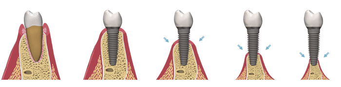 Bone Loss Image Dental Implants Salt Lake City, Utah