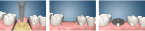 dental implant procedure salt lake city utah