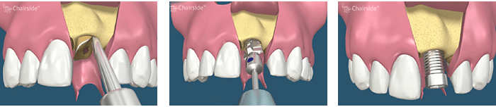 Salt Lake City Utah Dental Implant Procedure