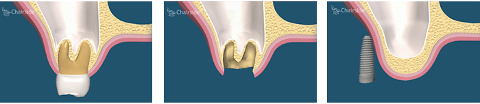 Salt Lake City Utah Dental Implant Procedure