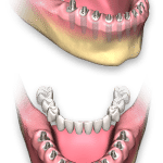 Dental Implant Utah Prosthetic Detailed Image