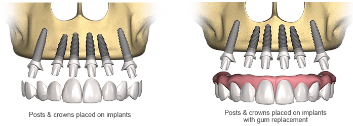 Dental Implant Prosthetic Procedure Dream Dental Utah
