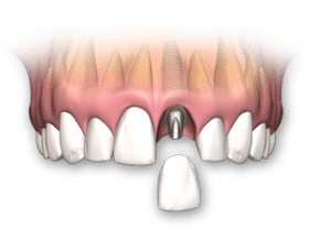 Dental Implant SLC Utah