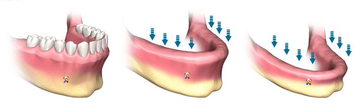 Jaw Bone Loss Timeline Dental Implants Salt Lake City