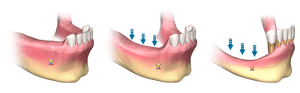 Multiple Tooth Bone Loss Dental Implants SLC Utah