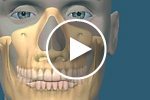 Sinus Grafting Dental Implants SLC Utah