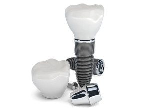 dental implants salt lake city ut