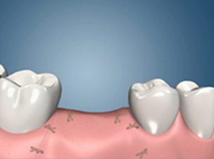 Dental Implant Procedure Salt Lake City Utah