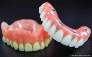 all on 4 dental implants salt lake city utah