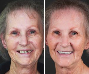 dental implants slc ut