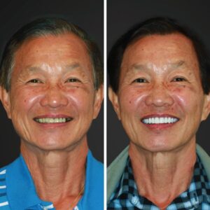 all on 4 dental implants before and after slc ut