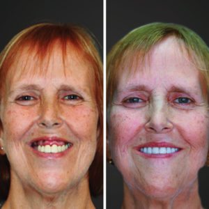 all on 4 dental implants before and after slc ut