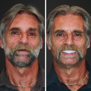 all on 4 dental implants before and after slc ut