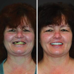 all on 4 dental implants before and after slc ut