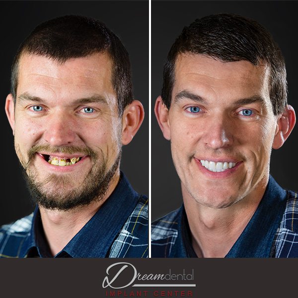 all on 4 dental implants before and after slc ut