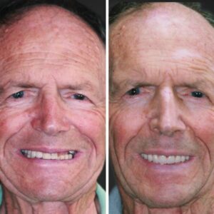 all on 4 dental implants salt lake city ut