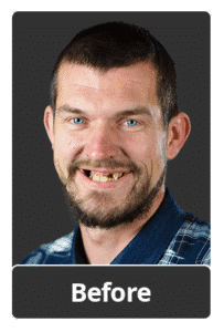 dental implant before photo salt lake city utah