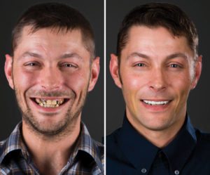 dental implants salt lake city utah