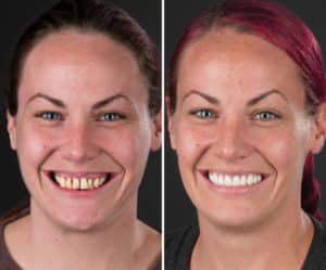 dental implants before and after salt lake city utah