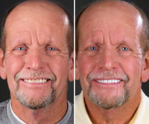 dental implants before and after slc utah