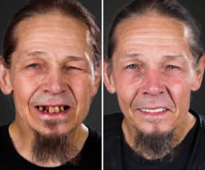 dental implants before and after slc utah