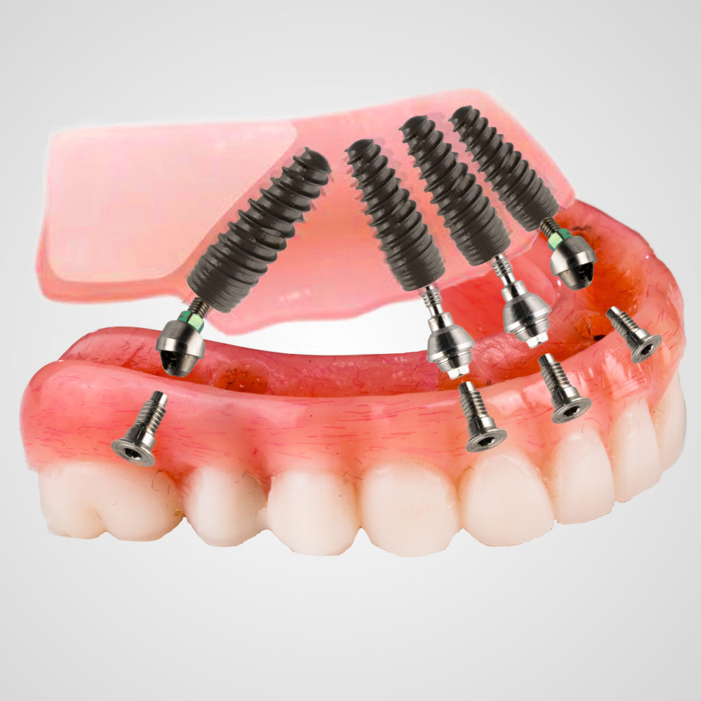 all-on-4-dental-implants-dream-dental-implant-center