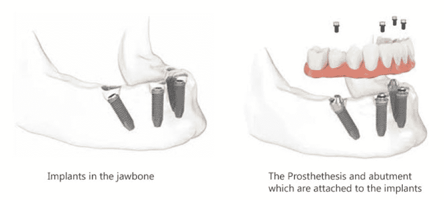 Implants being placed in lower jaw with dental implants diagram