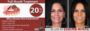 Dental Implants Discount