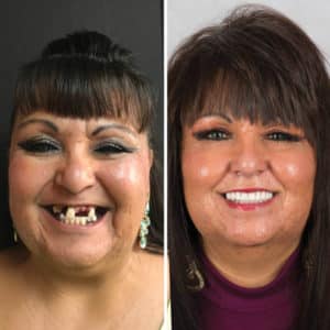 Dental Implant before and after all on 4 surgery
