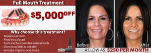 All on 4 dental Implants Discount