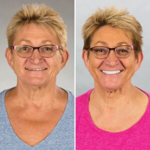 all on 4 surgery before and after