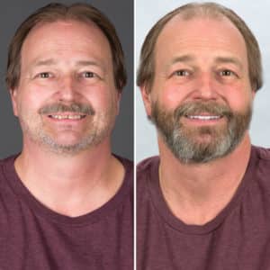 dental implants Utah