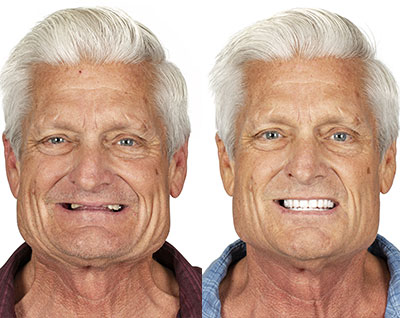 Before and After All on 4 Dental Implants