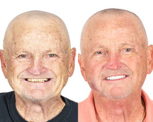 Before and After All on 4 Dental Implants