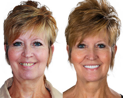 Before and After All on 4 Dental Implants