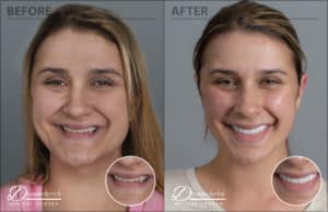Before and After All-on-4 Dental Implants